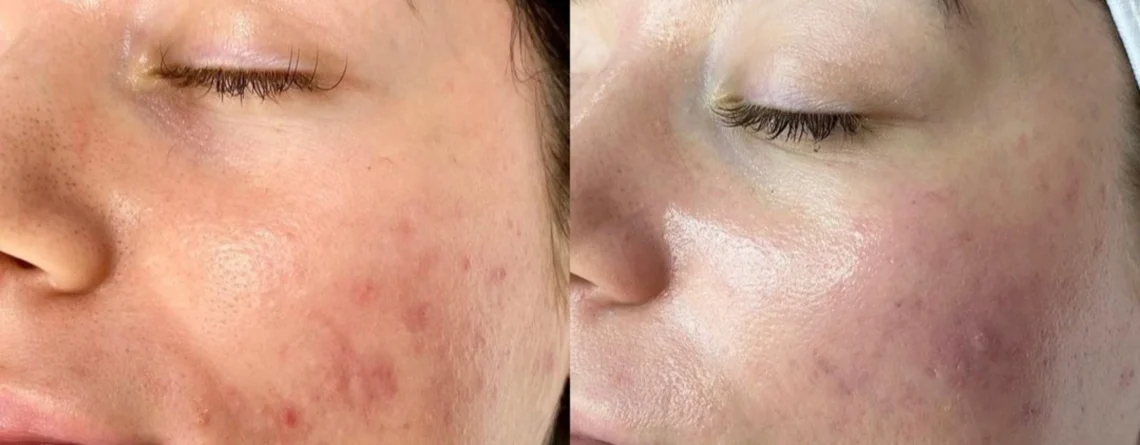 Kaip gydyti spuogus naudojant „Hydrafacial“: veikimo mechanizmas ir patarimai